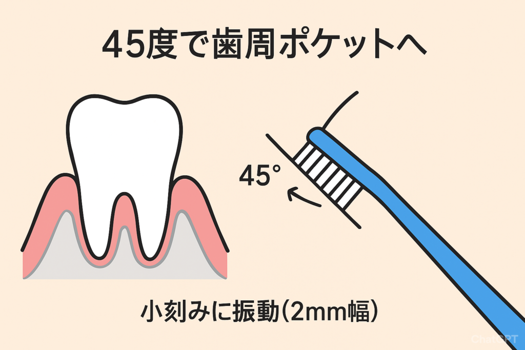 45度で歯周ポケットへ